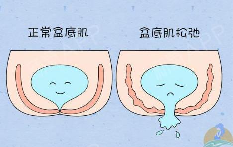有人会问什么是产后漏尿其实这种让人有口难开的漏尿现象在医学上被称