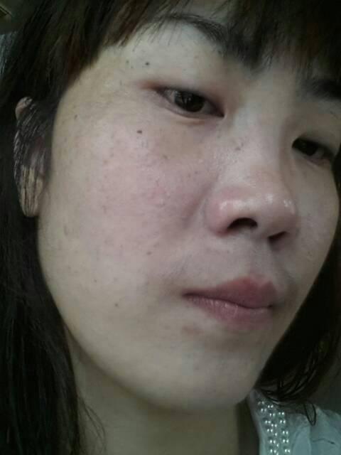 问:脸上皮肤长小痱子一样好多刺痒,又干,又点红是什么皮肤病
