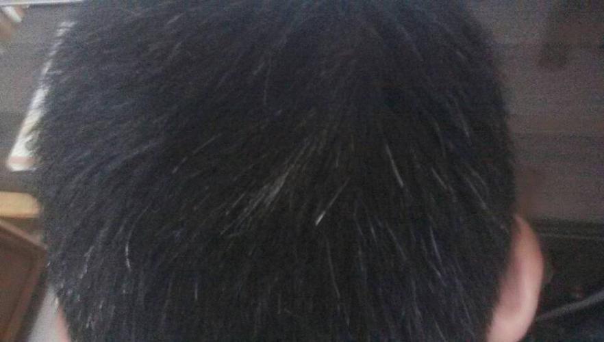 本人今年15了,初二生,但是后脑勺长了好多白头发,不敢