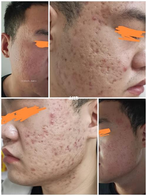 点阵激光术后四个月对比_点阵激光_美妆_医美整形