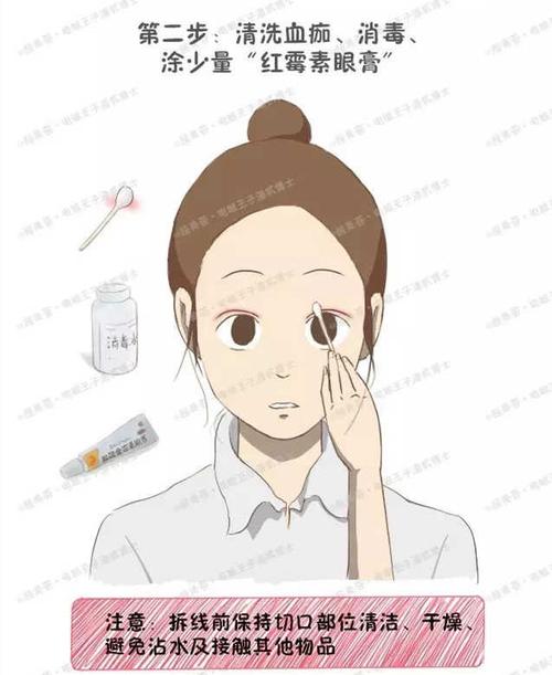 然后:用棉签沾消毒水清洗切口上的血痂即可,涂少量"红霉素眼膏".