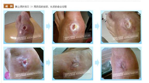 术后伤口不愈合怎么办?