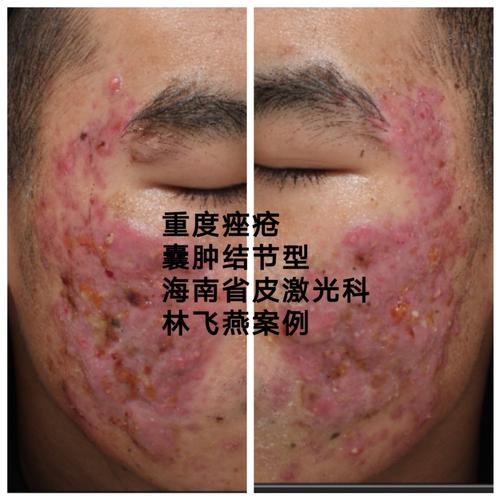 对颜值要求那么高,年轻人都特别怕脸上留下坑坑洼洼的痘坑