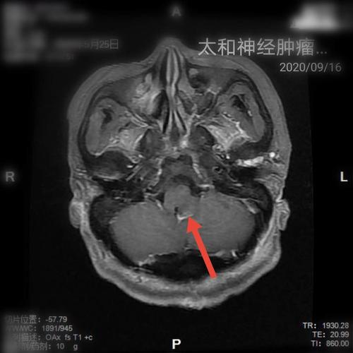 颅脑磁共振横轴位可见肿瘤信号消失
