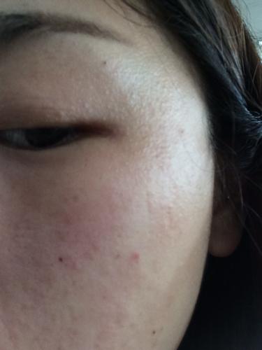 问:请问这样是过敏性皮炎还是什么?请问有什么禁忌,如何快速消除!