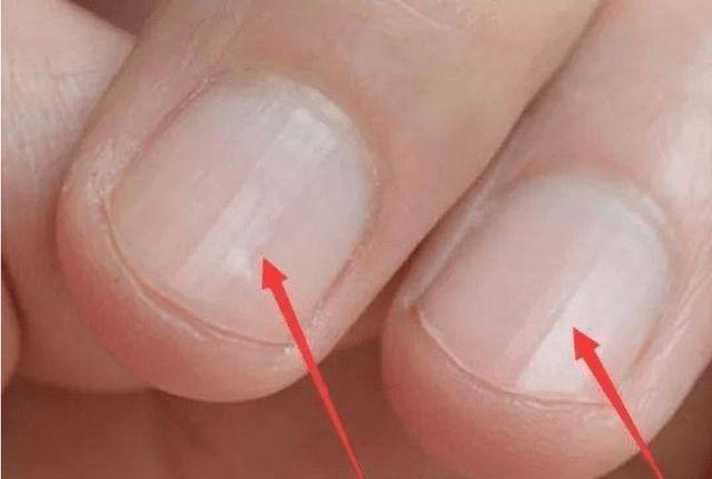 指甲出现竖纹是怎么回事看看医生是怎么说的