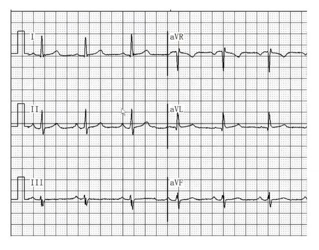 心律失常心电图分析牢记两项金规则occ2021