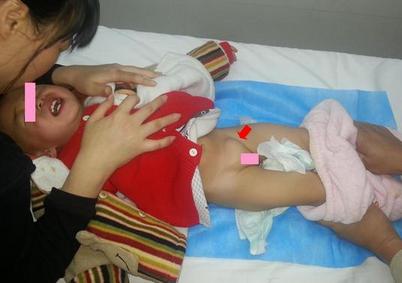 小儿疝气怎么调