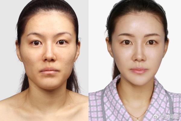 颧骨下方凹陷; 3,正面颧骨突出; 4,颧骨和颧弓同时突出,脸型凹凸不平