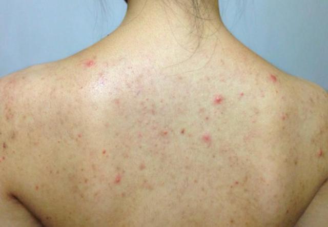 这些措施可有效预防痘痘