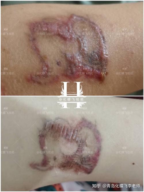 纹身又洗纹身,结果增生了,闹着玩吗?