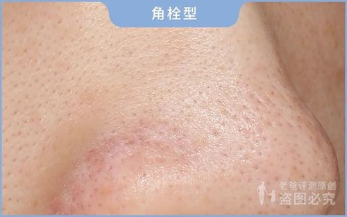 黑头究竟要怎么去我们拔出并放大了四种类型的黑头