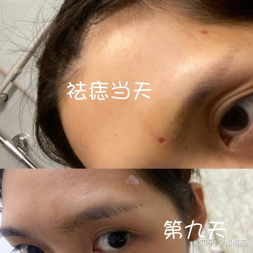 掉痂后有一点红红的,要继续涂抹药膏哟.