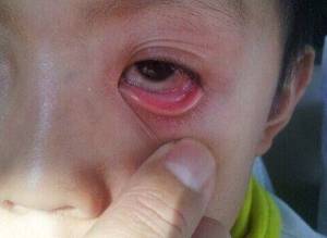 > 孩子结膜炎反复发作怎么办  结膜炎孩子用什么水洗脸 红眼病,其实就