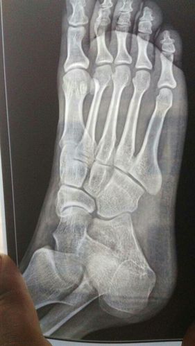 去医院拍了片子,医生说好像有点骨折,要等今天下午片子结婚出来,请问