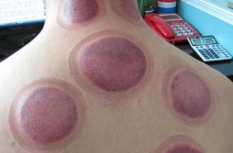 真相来了|拔罐|湿气_网易订阅