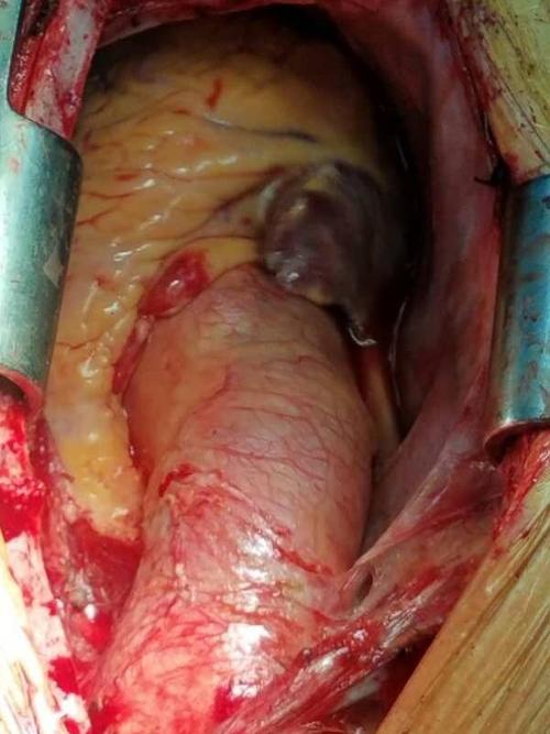 bentall手术——川北医附院心脏大血管外科常规开展手术,为川东北主