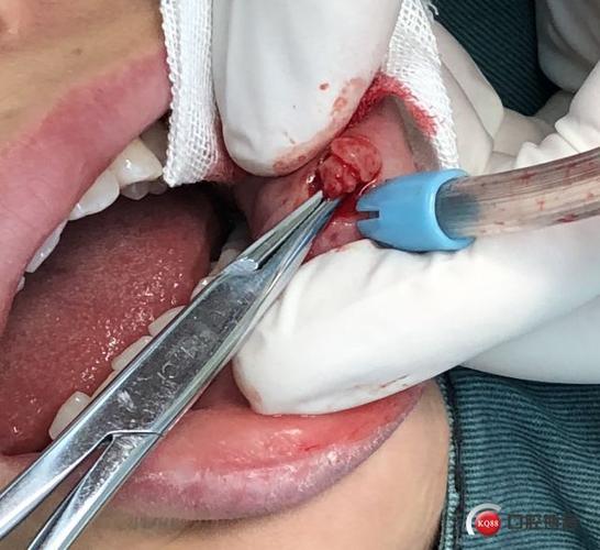 一例粘液腺囊肿局麻下摘除病例