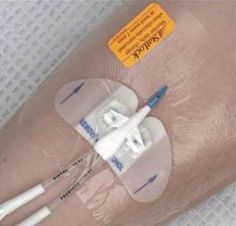 巴德思乐扣,导管固定装置