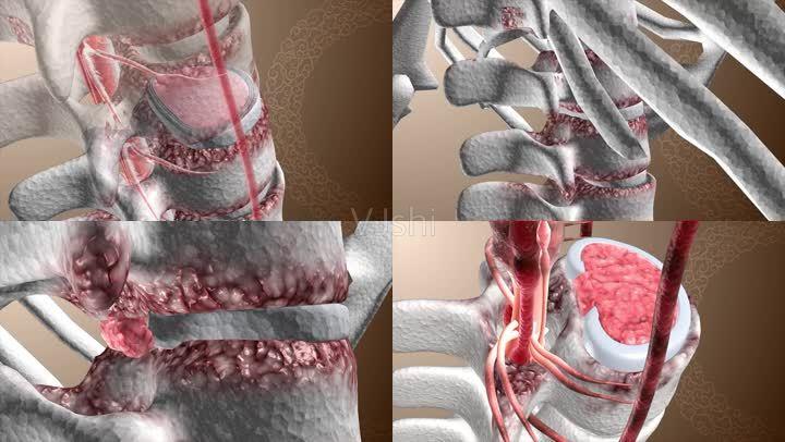 髓核突出 复发 腰椎 脊椎 纤维环破裂