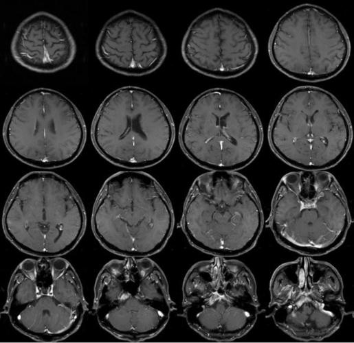 教你如何看头部核磁片