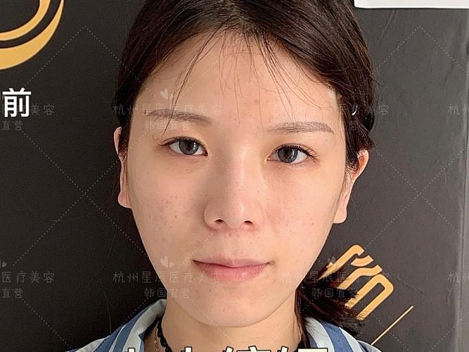 术前诊断术前人中偏长,人中沟平坦,人中窝不明显,整