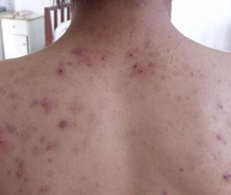 皮肤上长疥疮了好治吗