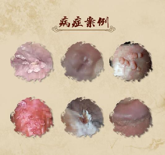 男性尖锐湿疣