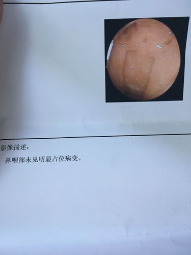 鼻内窥镜检查的结果,检查鼻咽部,请医生帮我看一下