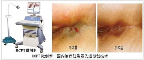 了解肛裂病因,症状及较佳治疗方法?