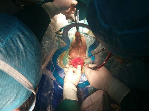 60岁男性,创伤性后尿道闭锁,长度约3cm,采用经会阴-膀胱直针吻合术