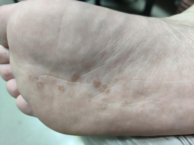 一只脚底长了一些小泡泡 很痒想问一下这是怎么回事
