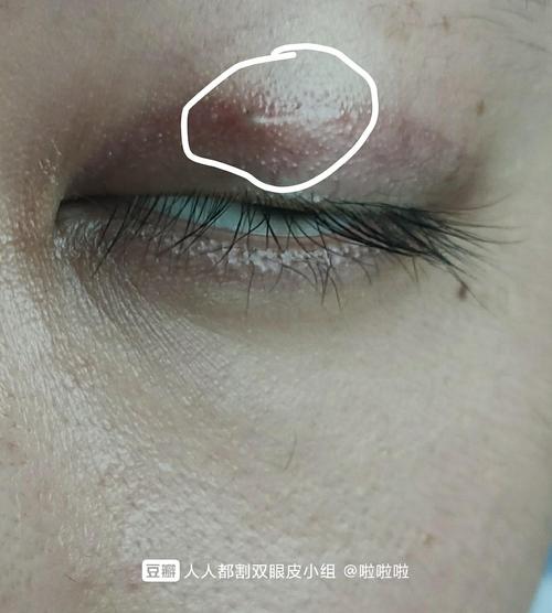 姐妹们,在双眼皮上长了个小疙瘩,这是疤痕增生还是痘痘呢?