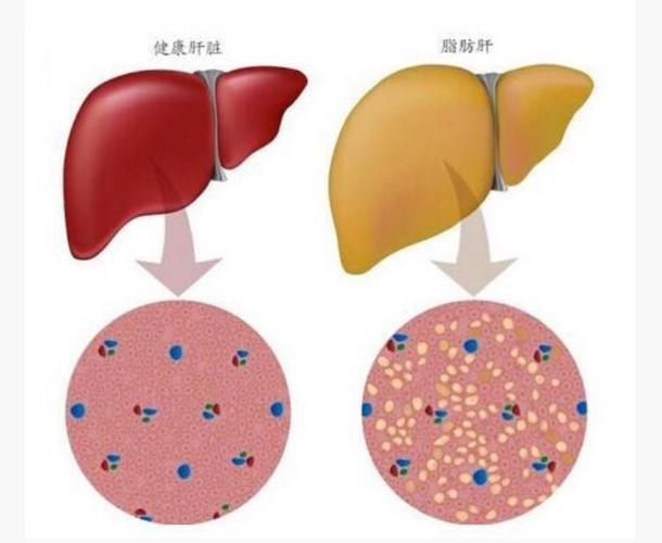 重视脂肪肝,重视肥胖儿童!