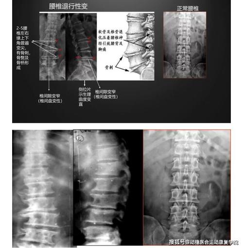 腰痛常见原因腰椎退行性变的x线片阅读