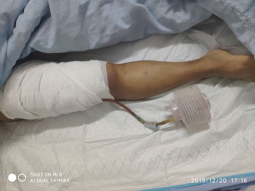 术后弹力绷带加压包扎,抗炎补液对症治疗.