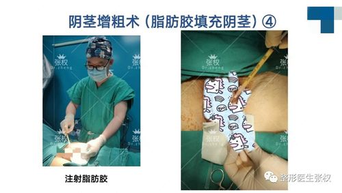 脂肪胶阴茎增粗术图解