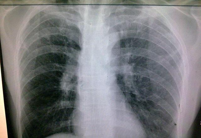 体检出有陈旧性肺结核是怎么回事