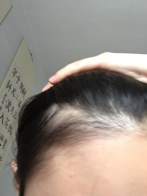 额头两边胎毛一边较少 所以刮掉了希望能长多点 但是已经半个月了 只