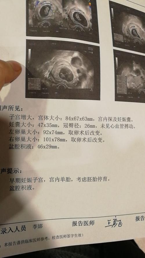 [试管婴儿]移植55天胚胎停育10月4移植