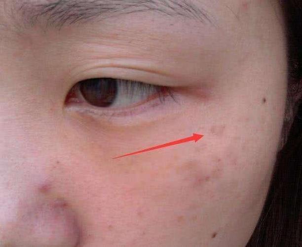 若眼睛出现2个特征,当心肝病已经