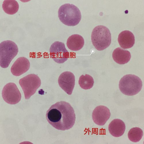 浆质体vs嗜多色性红细胞