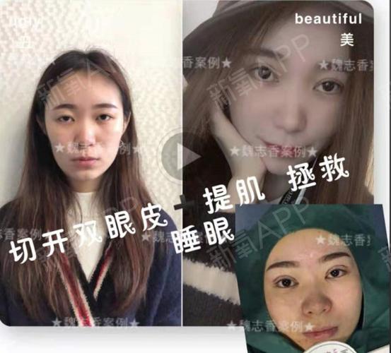 双眼皮提肌