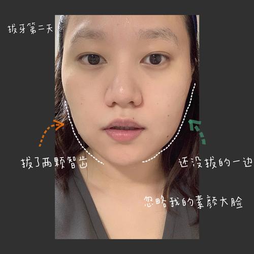 拔智齿改变脸型?请查收最全拔智齿攻略!
