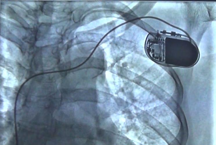 厉害了!中医院心内科成功开展首例永久性心脏起搏器植入手术