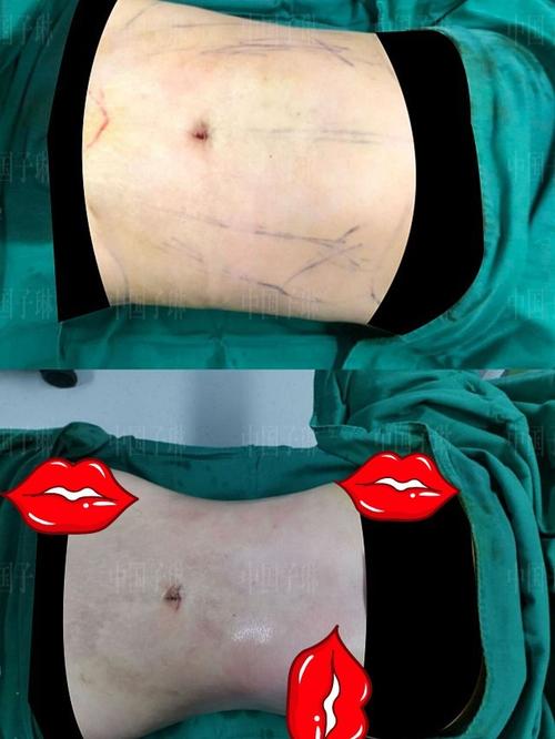 威塑腰腹环吸,术后即刻对比#威塑吸脂