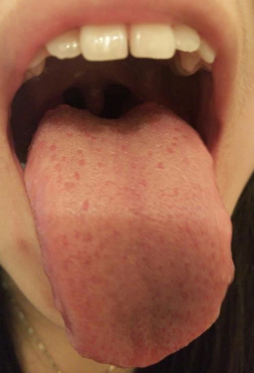 舌头上长了红色的疙瘩,怎么回事?有两三天了