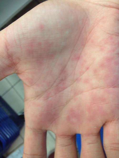 手掌出现很多红斑红点,最近去了新疆喝的是烧的自来水,什么原因?