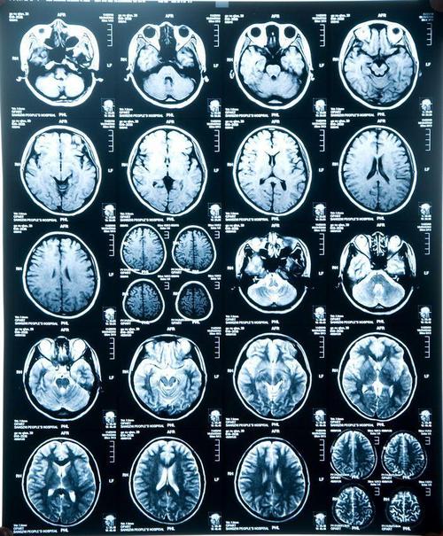 吃素就一定健康吗?某48岁女子被诊断脑萎缩,主要原因竟是吃素