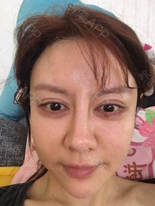 玻尿酸